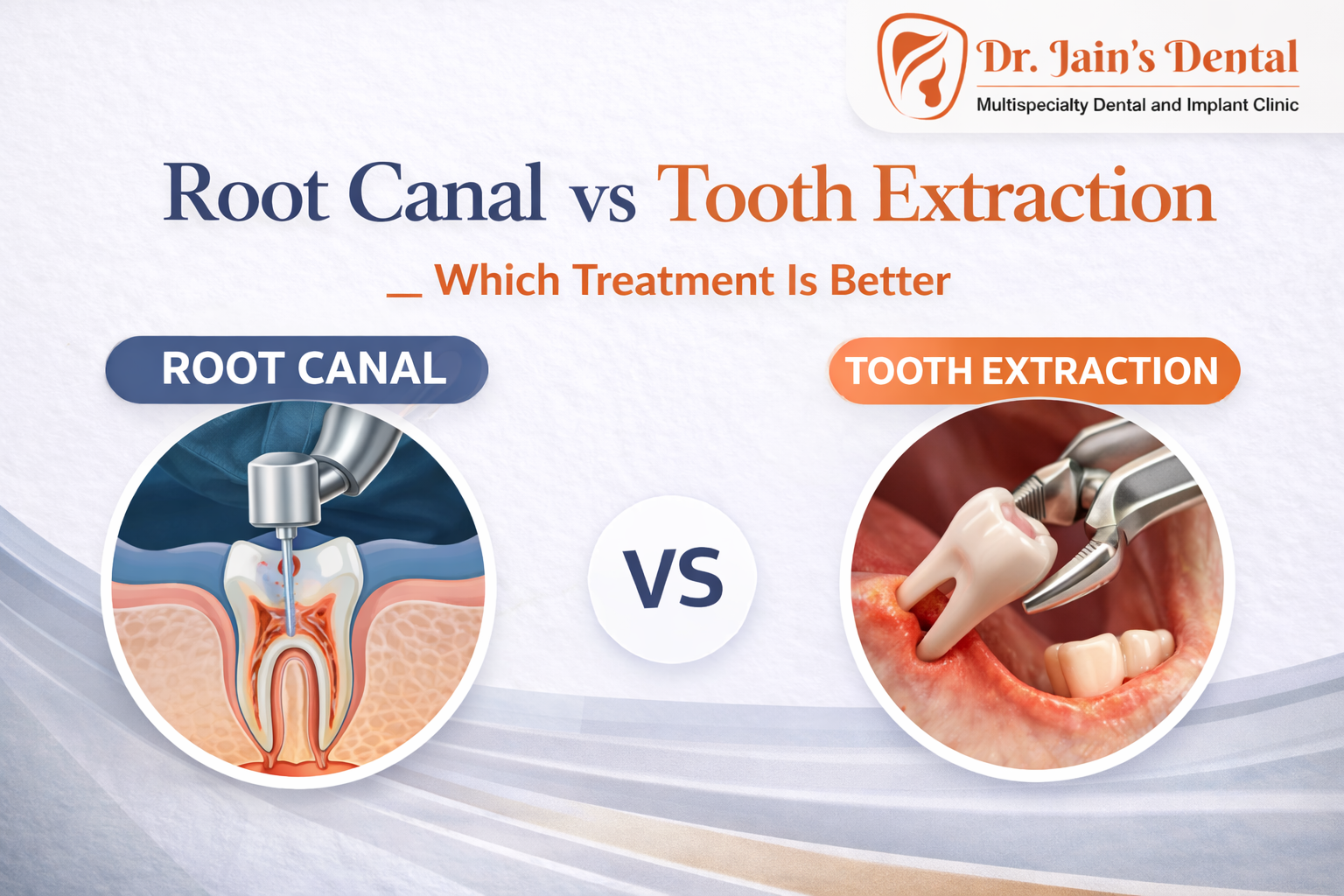 Root Canal vs Tooth Extraction: Which Treatment Is Better?